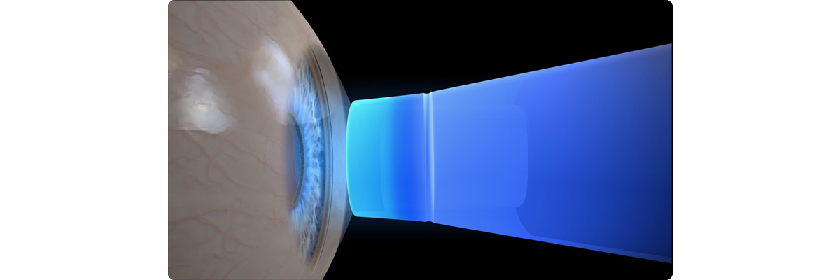 Screening Glaucoma